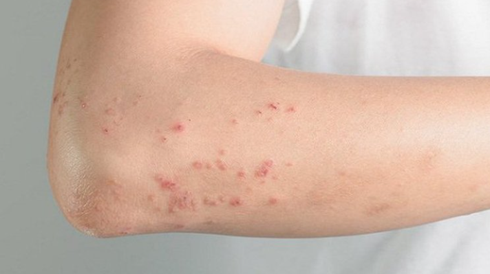 Nằm Mơ Thấy Mình Bị AIDS: Nỗi Lo Lắng và Giải Mã Ý Nghĩa Ku bet