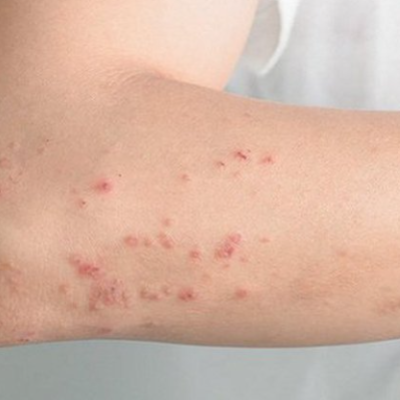 Nằm Mơ Thấy Mình Bị AIDS: Nỗi Lo Lắng và Giải Mã Ý Nghĩa Ku bet